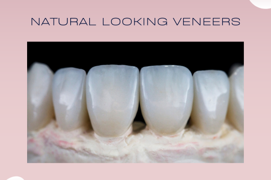 Dental Veneers