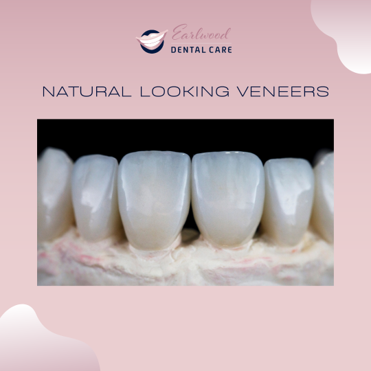 Dental Veneers