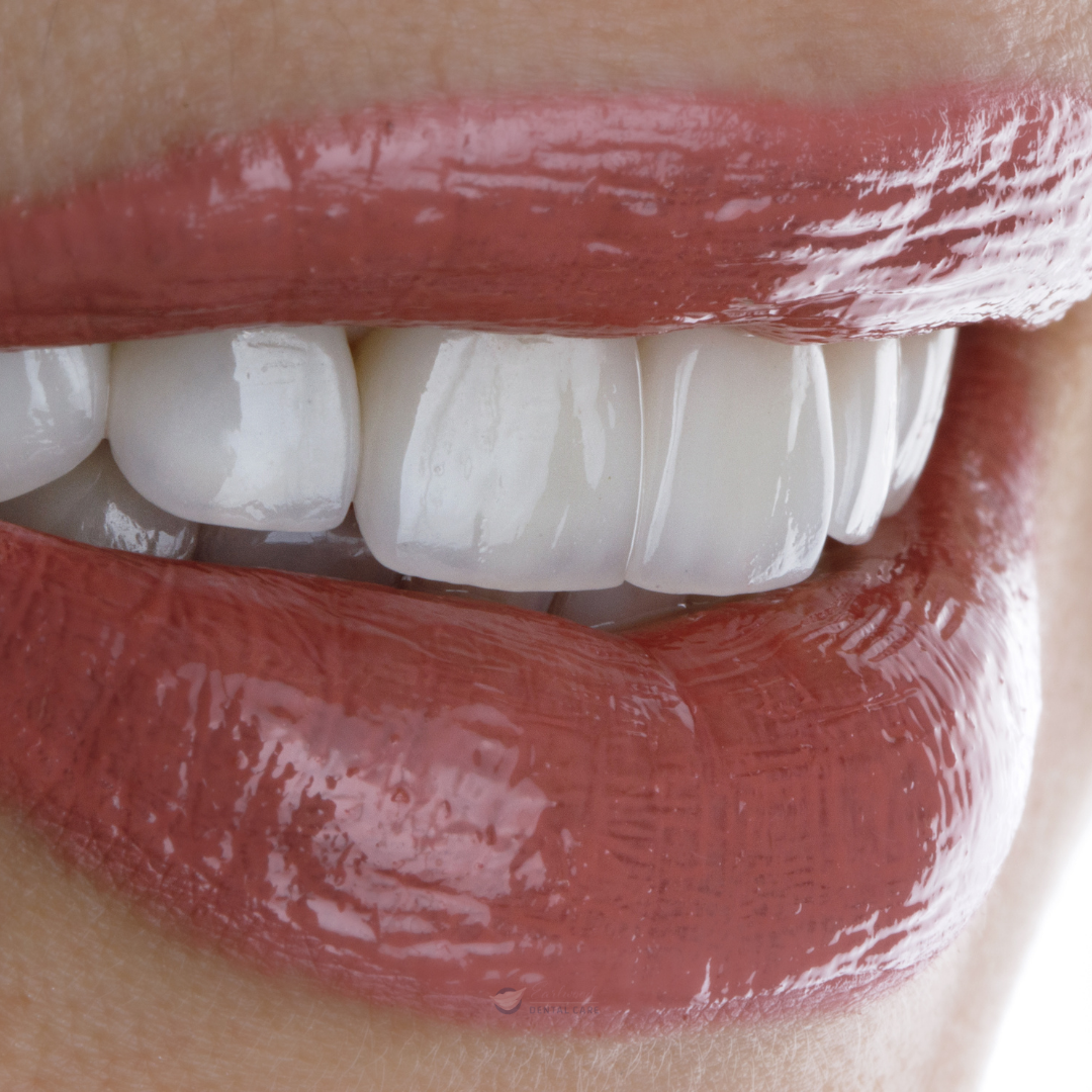Veneers