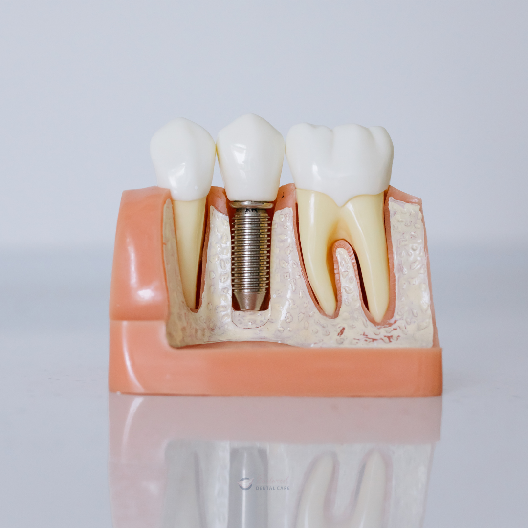 dental implant